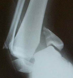fracture ankle